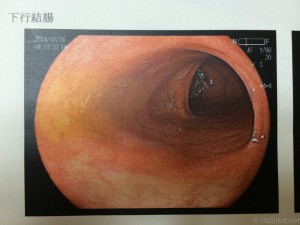 大腸内視鏡 下行結腸